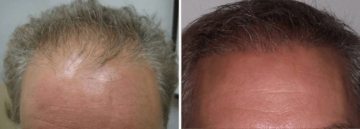Patient hair restoration result