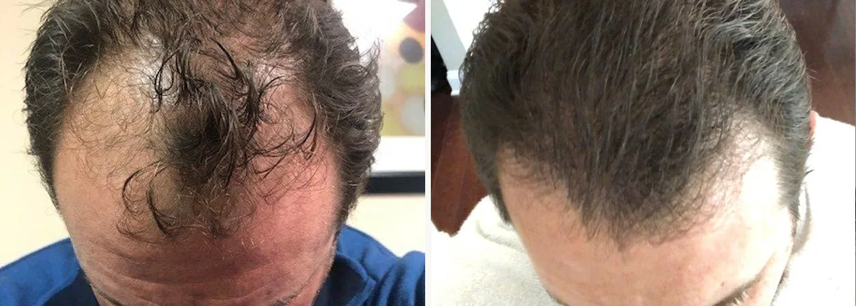 Hair restoration before and after