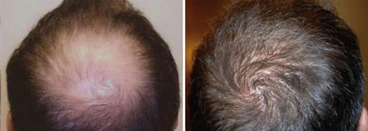 Hair restoration before and after