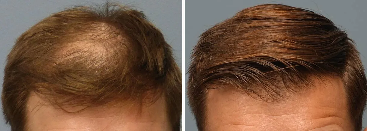 Hair restoration before and after