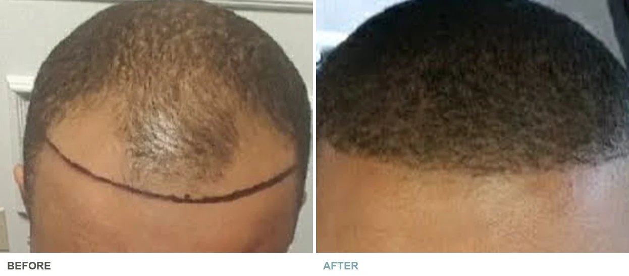 Hair restoration before and after — actual patient