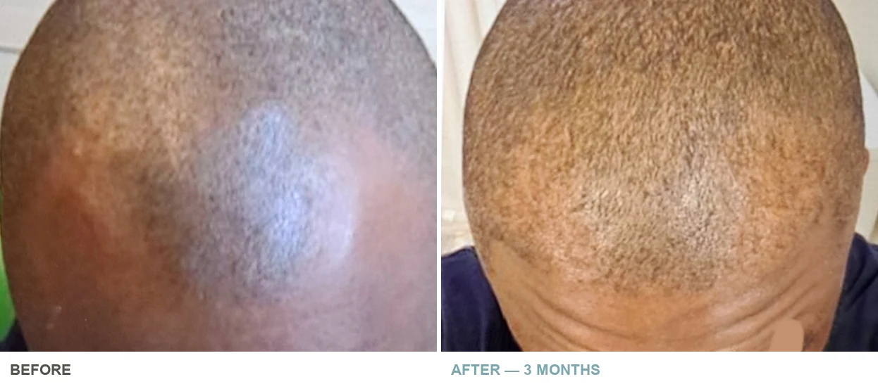 Hair restoration before and after at three months — actual patient